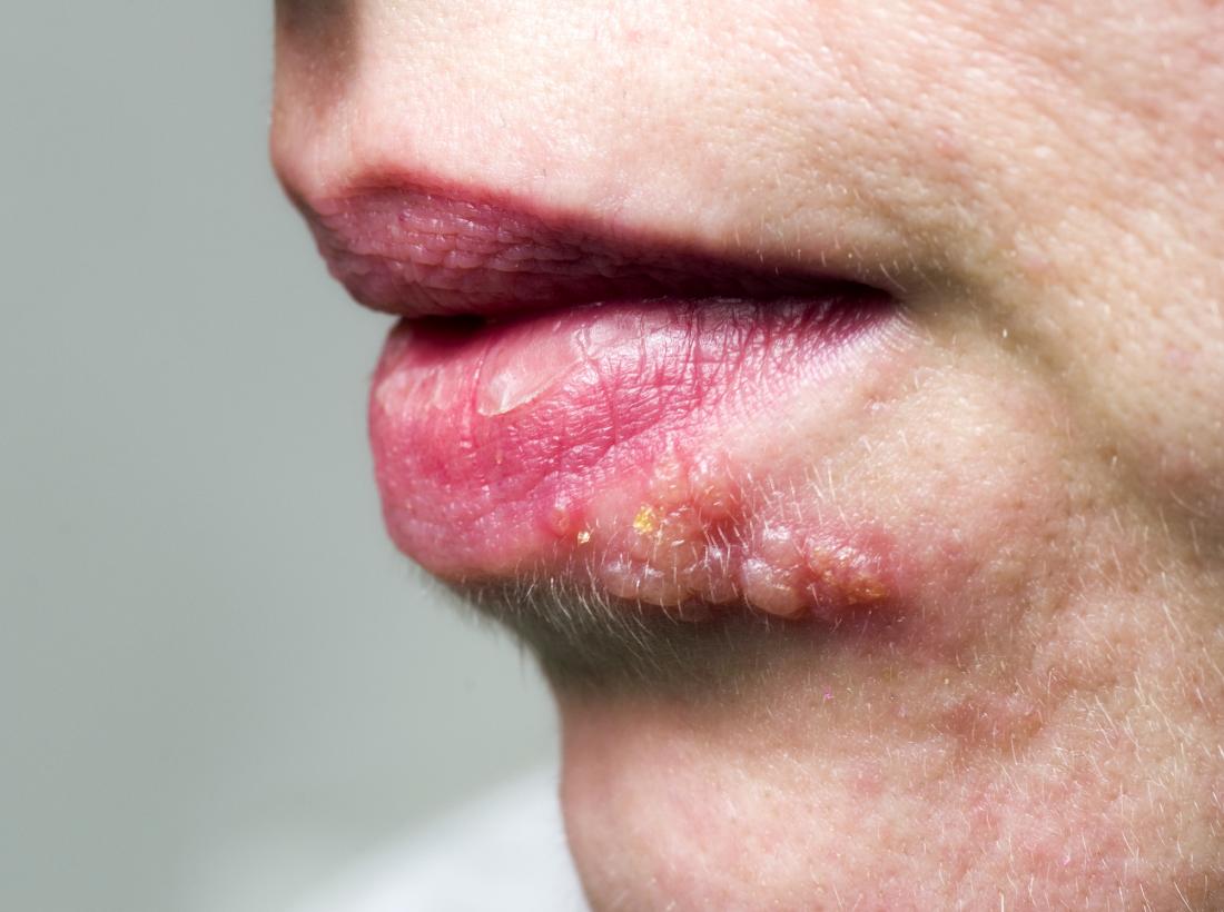 How to treat shingles on the face